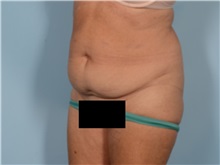 Tummy Tuck Before Photo by Ellen Janetzke, MD; ,  - Case 50530