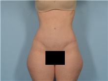 Tummy Tuck After Photo by Ellen Janetzke, MD; ,  - Case 50529