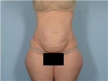 Tummy Tuck Before Photo by Ellen Janetzke, MD; ,  - Case 50529