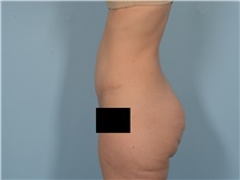 Tummy Tuck After Photo by Ellen Janetzke, MD; ,  - Case 50529
