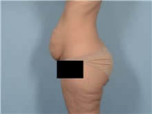 Tummy Tuck Before Photo by Ellen Janetzke, MD; ,  - Case 50529