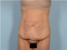 Tummy Tuck Before Photo by Ellen Janetzke, MD; ,  - Case 50532