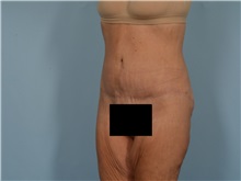 Tummy Tuck After Photo by Ellen Janetzke, MD; ,  - Case 50532