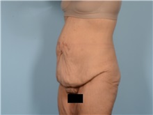 Tummy Tuck Before Photo by Ellen Janetzke, MD; ,  - Case 50532
