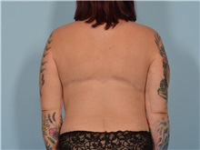 Body Lift After Photo by Ellen Janetzke, MD; ,  - Case 50623