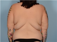 Body Lift Before Photo by Ellen Janetzke, MD; ,  - Case 50623