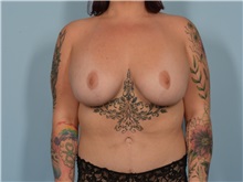 Breast Augmentation After Photo by Ellen Janetzke, MD; ,  - Case 50624