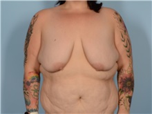 Breast Augmentation Before Photo by Ellen Janetzke, MD; ,  - Case 50624