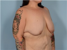 Breast Augmentation Before Photo by Ellen Janetzke, MD; ,  - Case 50624