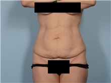 Tummy Tuck Before Photo by Ellen Janetzke, MD; ,  - Case 50621