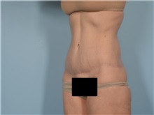 Tummy Tuck After Photo by Ellen Janetzke, MD; ,  - Case 50621