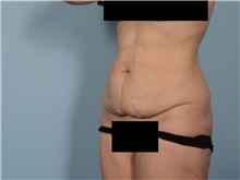 Tummy Tuck Before Photo by Ellen Janetzke, MD; ,  - Case 50621