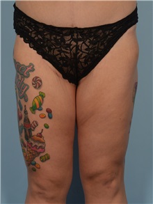 Thigh Lift After Photo by Ellen Janetzke, MD; ,  - Case 50625