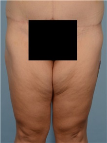 Thigh Lift Before Photo by Ellen Janetzke, MD; ,  - Case 50625
