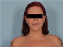 Liposuction After Photo by Ellen Janetzke, MD; ,  - Case 50627
