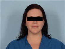 Liposuction Before Photo by Ellen Janetzke, MD; ,  - Case 50627