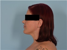 Liposuction After Photo by Ellen Janetzke, MD; ,  - Case 50627