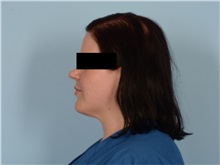 Liposuction Before Photo by Ellen Janetzke, MD; ,  - Case 50627