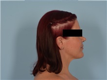 Liposuction After Photo by Ellen Janetzke, MD; ,  - Case 50627