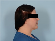 Liposuction Before Photo by Ellen Janetzke, MD; ,  - Case 50627