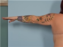Arm Lift After Photo by Ellen Janetzke, MD; ,  - Case 50626