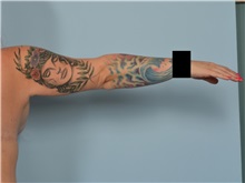 Arm Lift After Photo by Ellen Janetzke, MD; ,  - Case 50626