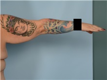 Arm Lift Before Photo by Ellen Janetzke, MD; ,  - Case 50626