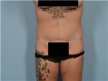 Tummy Tuck After Photo by Ellen Janetzke, MD; ,  - Case 50622