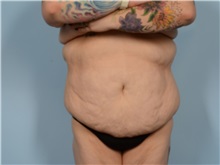 Tummy Tuck Before Photo by Ellen Janetzke, MD; ,  - Case 50622