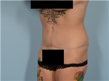 Tummy Tuck After Photo by Ellen Janetzke, MD; ,  - Case 50622