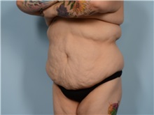 Tummy Tuck Before Photo by Ellen Janetzke, MD; ,  - Case 50622