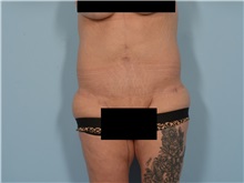 Tummy Tuck After Photo by Ellen Janetzke, MD; ,  - Case 50714