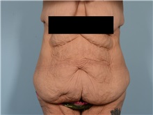 Tummy Tuck Before Photo by Ellen Janetzke, MD; ,  - Case 50714