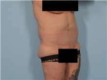 Tummy Tuck After Photo by Ellen Janetzke, MD; ,  - Case 50714