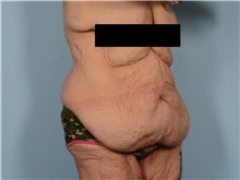 Tummy Tuck Before Photo by Ellen Janetzke, MD; ,  - Case 50714