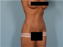 Tummy Tuck After Photo by Ellen Janetzke, MD; Bloomfield Hills, MI - Case 50847