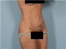 Tummy Tuck Before Photo by Ellen Janetzke, MD; Bloomfield Hills, MI - Case 50847