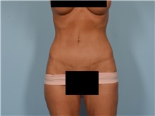 Tummy Tuck After Photo by Ellen Janetzke, MD; Bloomfield Hills, MI - Case 50847
