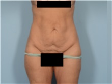 Tummy Tuck Before Photo by Ellen Janetzke, MD; Bloomfield Hills, MI - Case 50847
