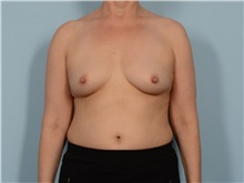 Breast Augmentation Before Photo by Ellen Janetzke, MD; Bloomfield Hills, MI - Case 50846