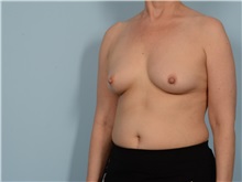 Breast Augmentation Before Photo by Ellen Janetzke, MD; Bloomfield Hills, MI - Case 50846