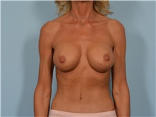 Breast Augmentation After Photo by Ellen Janetzke, MD; Bloomfield Hills, MI - Case 50845