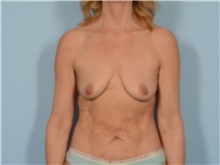 Breast Augmentation Before Photo by Ellen Janetzke, MD; Bloomfield Hills, MI - Case 50845
