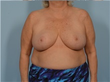 Breast Reduction After Photo by Ellen Janetzke, MD; Bloomfield Hills, MI - Case 50856