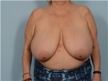 Breast Reduction Before Photo by Ellen Janetzke, MD; Bloomfield Hills, MI - Case 50856