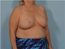Breast Reduction After Photo by Ellen Janetzke, MD; Bloomfield Hills, MI - Case 50856