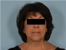 Facial Feminization After Photo by Ellen Janetzke, MD; Bloomfield Hills, MI - Case 50934