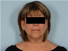 Facial Feminization Before Photo by Ellen Janetzke, MD; Bloomfield Hills, MI - Case 50934