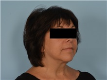 Facial Feminization After Photo by Ellen Janetzke, MD; Bloomfield Hills, MI - Case 50934