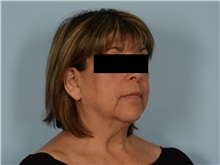 Facial Feminization Before Photo by Ellen Janetzke, MD; Bloomfield Hills, MI - Case 50934